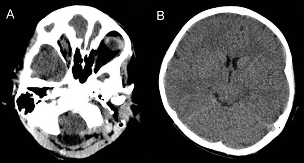 A rare case of delayed SAH after Chiari decompression