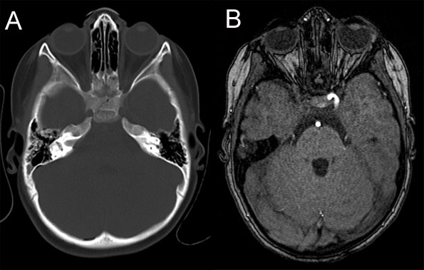 Blunt trauma and intracranial vascular injury