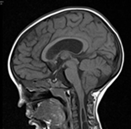 ‘Routine’ Foramen Magnum decompression for Type I Chiari malformation 